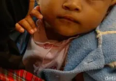 RS Hermina Bogor Gelar Operasi Bibir Sumbing Gratis, 17 Anak Raih Senyum Baru