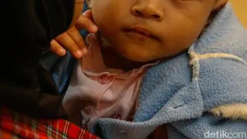 RS Hermina Bogor Gelar Operasi Bibir Sumbing Gratis, 17 Anak Raih Senyum Baru