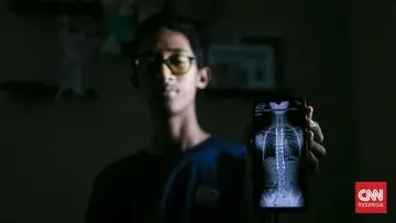 Titanium, Sahabat Seumur Hidup dalam Perjuangan Melawan Skoliosis