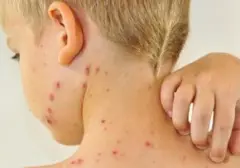Cacar Ular (Herpes Zoster) Ternyata Menular, Ini Penjelasan Lengkapnya
