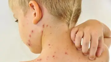 Cacar Ular (Herpes Zoster) Ternyata Menular, Ini Penjelasan Lengkapnya