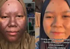 Kisah Pemulihan Kulit Wajah Pasca Penggunaan Skincare Merkuri: Dari Gelap Menjadi Sehat