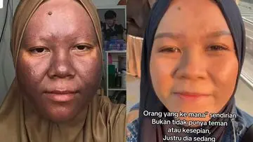 Kisah Pemulihan Kulit Wajah Pasca Penggunaan Skincare Merkuri: Dari Gelap Menjadi Sehat