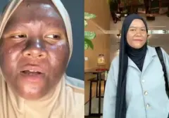 Krim Merkuri Penggelap Kulit: Kisah Pemulihan Seorang Wanita yang Viral