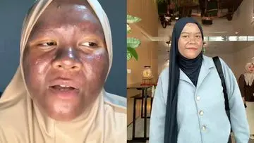 Krim Merkuri Penggelap Kulit: Kisah Pemulihan Seorang Wanita yang Viral