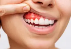 Gusi Berdarah: Gejala Awal Penyakit Serius, dari Jantung hingga Diabetes