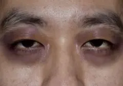 Mengenal 'Raccoon Eyes': Lingkaran Hitam di Bawah Mata, Bukan Sekadar Lelah tapi Bisa Jadi Gejala Serius