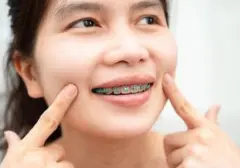 Mengapa Pengguna Behel Sering Gerakkan Bibir Seperti 'Iyup', Dokter Gigi Jelaskan Alasannya
