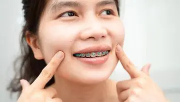 Mengapa Pengguna Behel Sering Gerakkan Bibir Seperti 'Iyup', Dokter Gigi Jelaskan Alasannya