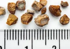 Pakar Urologi Ungkap Pemicu Tingginya Kasus Batu Ginjal di Indonesia