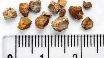Pakar Urologi Ungkap Pemicu Tingginya Kasus Batu Ginjal di Indonesia