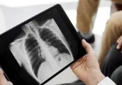 Bahaya Asap Karhutla: Ancaman Pneumonia dan Gangguan Pernapasan Lainnya