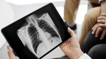 Bahaya Asap Karhutla: Ancaman Pneumonia dan Gangguan Pernapasan Lainnya