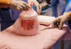 Pria AS Raih Rekor Transplantasi Ginjal Babi 271 Hari, Langkah Maju Terapi Xenotransplantasi