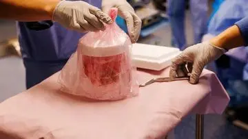 Pria AS Raih Rekor Transplantasi Ginjal Babi 271 Hari, Langkah Maju Terapi Xenotransplantasi