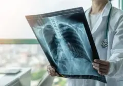 Studi Terbaru Ungkap Kadar Mikroplastik Tinggi pada Pasien Kanker Paru-paru, Kaitan dengan Polusi Dipertanyakan