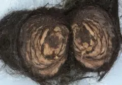 Gumpalan Rambut 1,5 Kg Berhasil Diangkat dari Perut Gadis 16 Tahun di AS