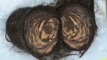 Gumpalan Rambut 1,5 Kg Berhasil Diangkat dari Perut Gadis 16 Tahun di AS