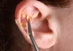 Terapi Ear Seeds: Tren Atasi Stres yang Digandrungi Idol K-Pop, Benarkah Efektif?